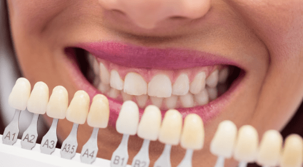 5 Best Dental Implants for a Perfect Smile 2 Dental Implants