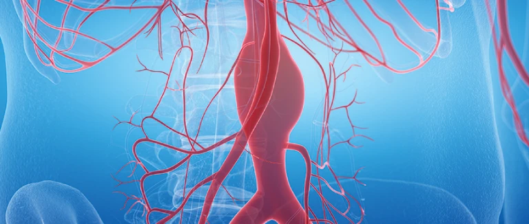 Scalpel-Free Treatment for Brain Aneurysms 2 Scalpel-Free Treatment