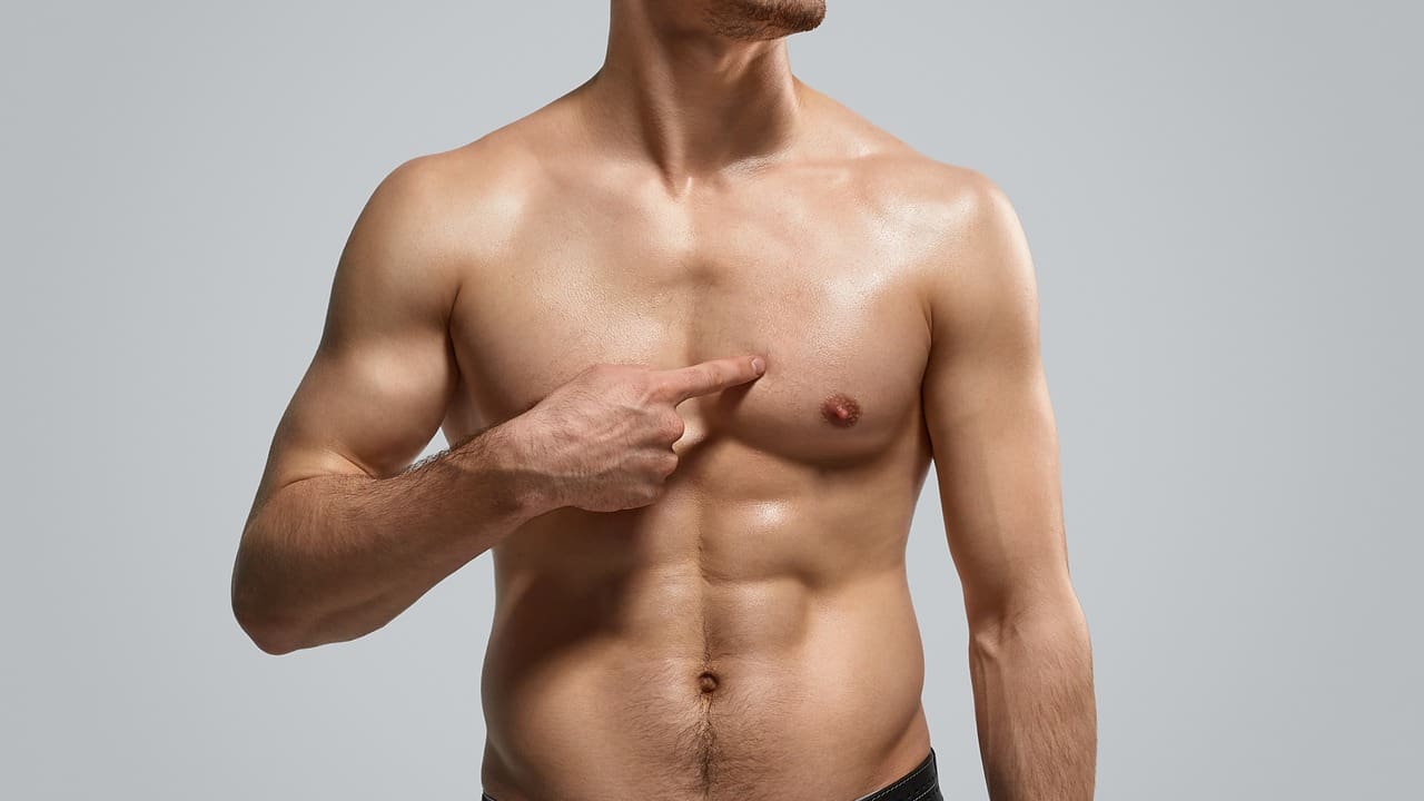 Gynecomastia