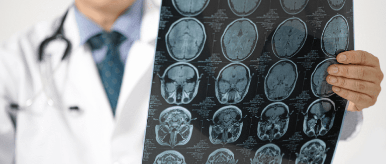 Brain Tumor Symptoms: Absolute Guide 3 Brain Tumor