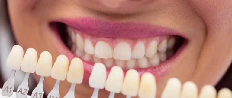 Zirconium Veneer: Stunning Smile in 5 Steps 1 Zirconium Veneer