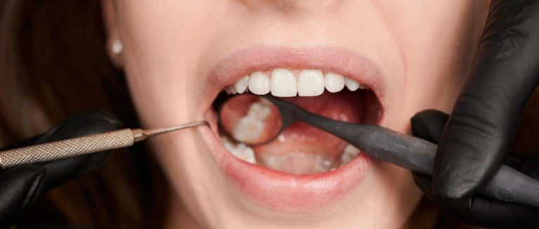 Zirconium Veneer: Stunning Smile in 5 Steps 2 Zirconium Veneer