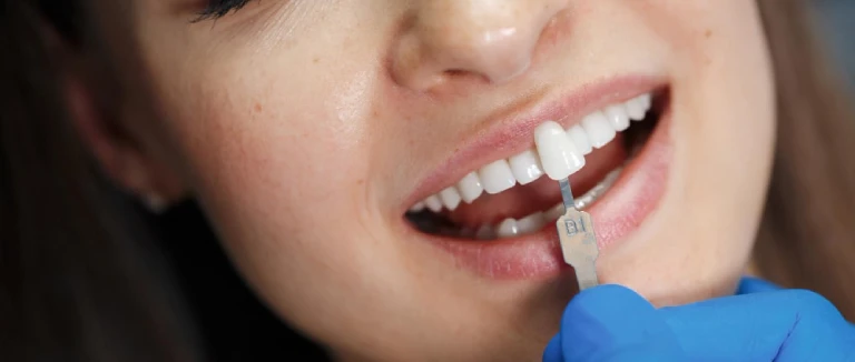 Zirconium Veneer: Stunning Smile in 5 Steps 3 Zirconium Veneer