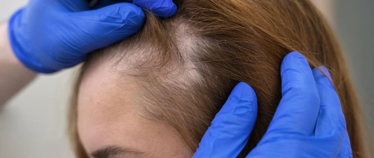 Fue Hair Transplant: Top Benefits 2 Fue Hair Transplant
