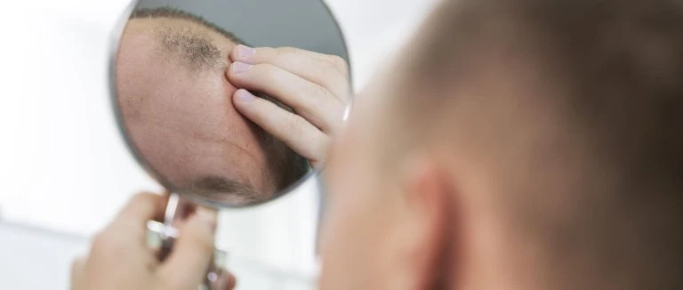 Fue Hair Transplant: Top Benefits 3 Fue Hair Transplant