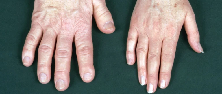 Acromegaly: 5 Critical Facts You Must Know 1 Acromegaly