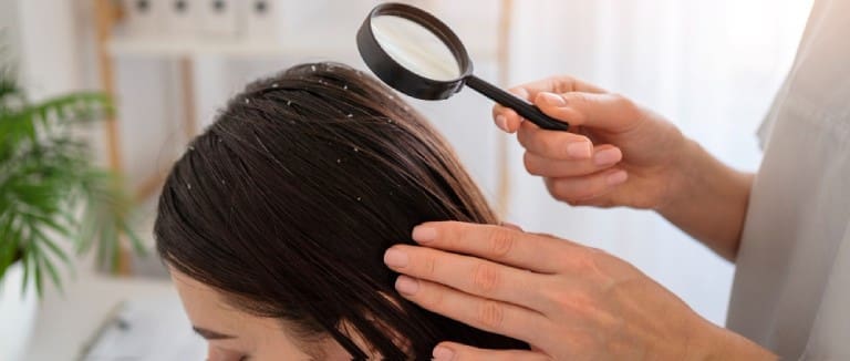 Scalp Eczema: 5 Effective Care Tips 1 Scalp eczema
