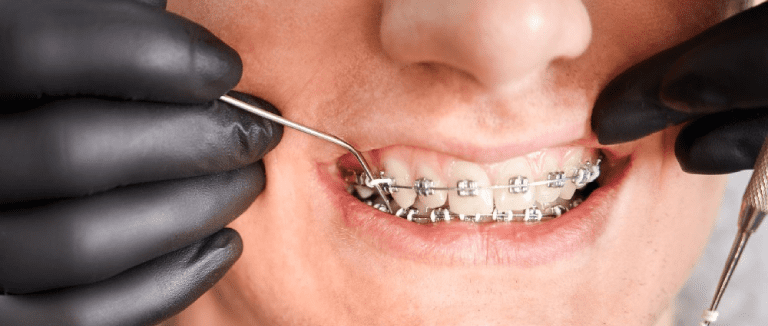 Orthodontics: Perfect Smile Transformation 5 orthodontics