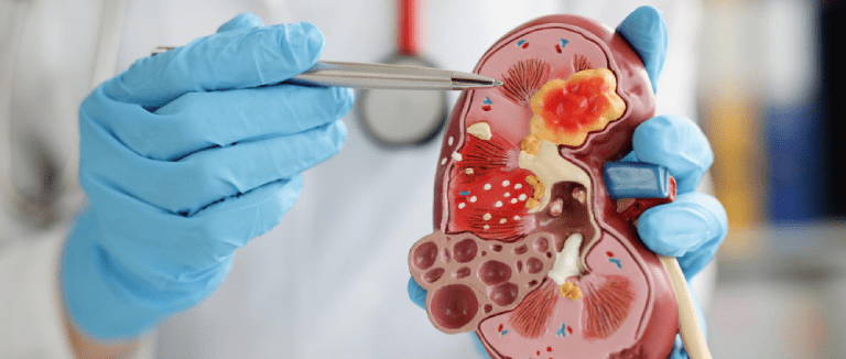 Kidney Transplantation: 5 Powerful Tips 1 Kidney Transplantation