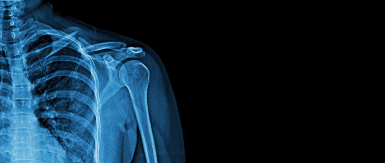 Arthroplasty: 5 Easy Joint Fixes 4 Arthroplasty