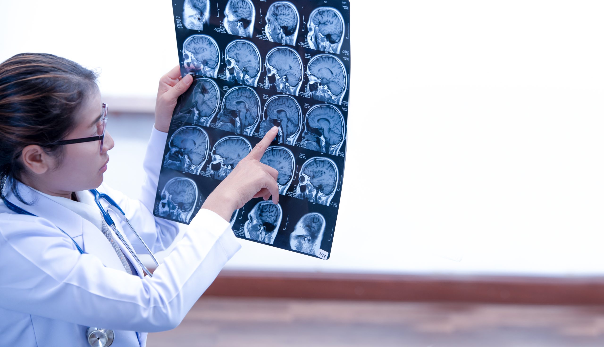 Silent Brain Tumor: Signs, Timelines, and How They're Found