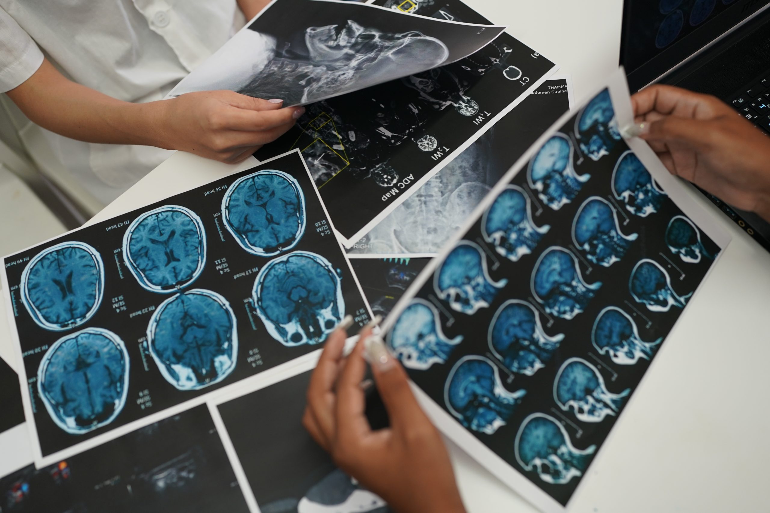 will a SPECT scan show a brain tumor