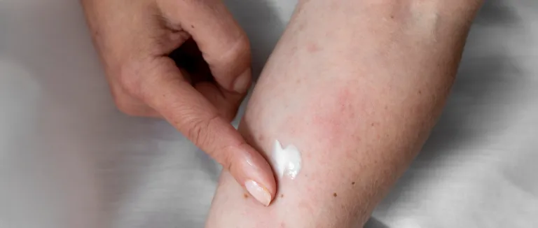 Monkeypox Virus: Essential Facts & Care 3 image 100 LIV Hospital