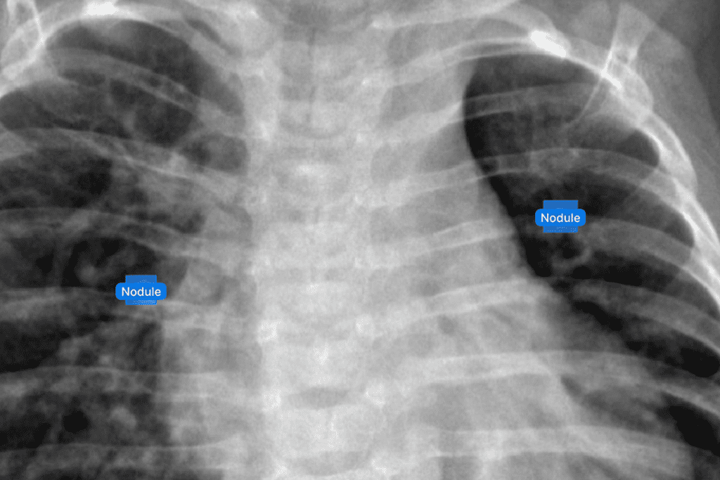 PET Scan Lung Nodule Cancer Detection: Accuracy and Test Guidelines