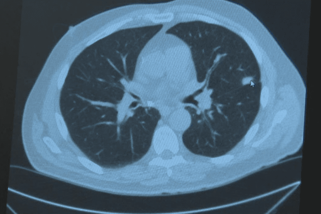 Absolutely: Can PET Scan Detect Cancer Better Than CT Scan