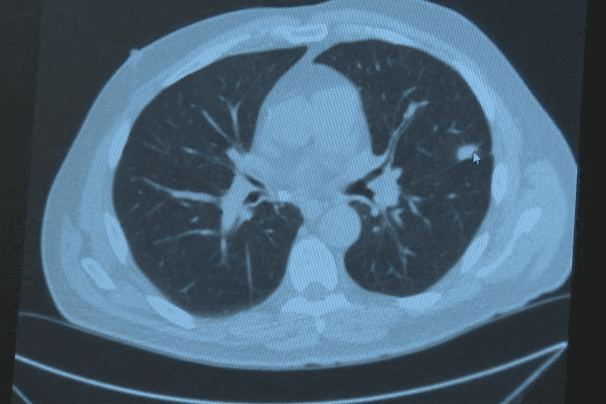 Absolutely: Can PET Scan Detect Cancer Better Than CT Scan