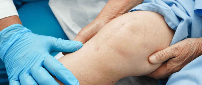 Arthroplasty: 5 Easy Joint Fixes 2 Arthroplasty