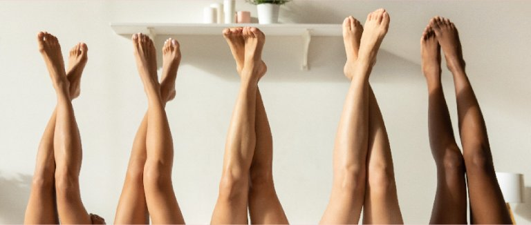 Varicose Veins: Smart Tips for Relief 2 Varicose