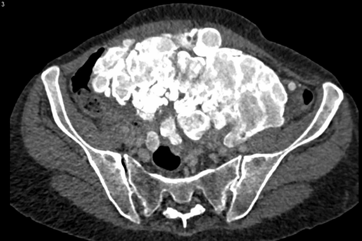 CT Scan Detect Metastasis Cancer Spread: Powerful & Accurate Detection