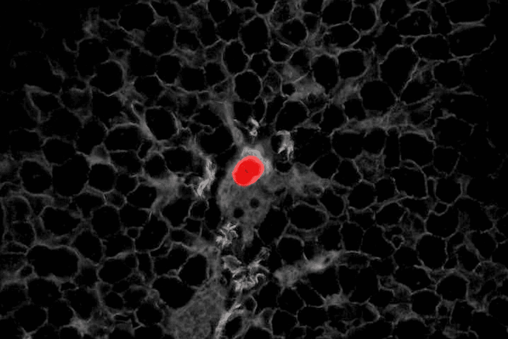 Cancers detected by PET scan