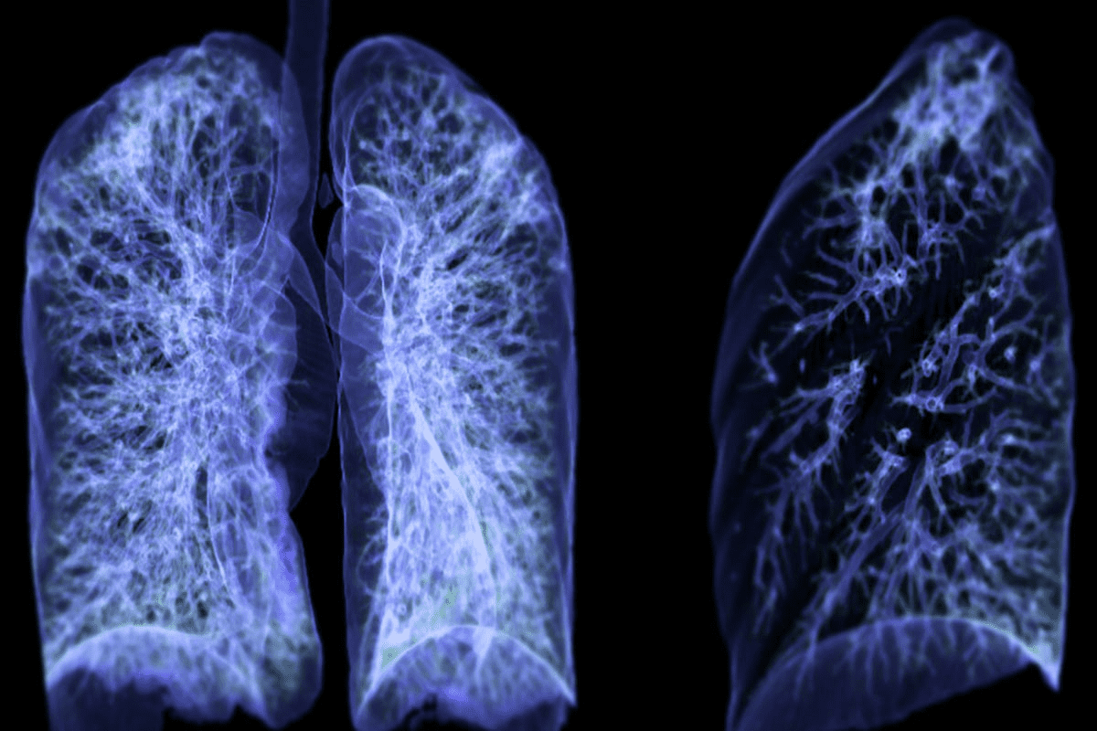 Lung Cancer Staging Imaging: PET, CT, and MRI for Accurate Assessment