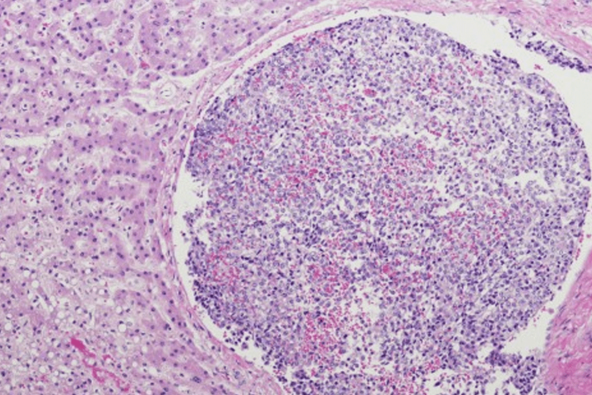 How Hepatoblastoma Presents: Key Symptoms and Warning Signs