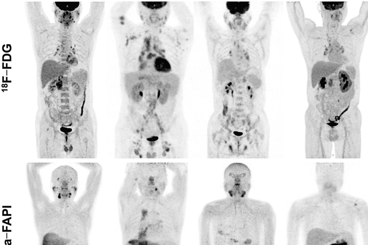 PET Scan Black Spots Meaning: What Radiologists Look for in Imaging