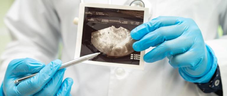 Myoma Surgery: Comfortable Recovery Guide 3 Myoma Surgery