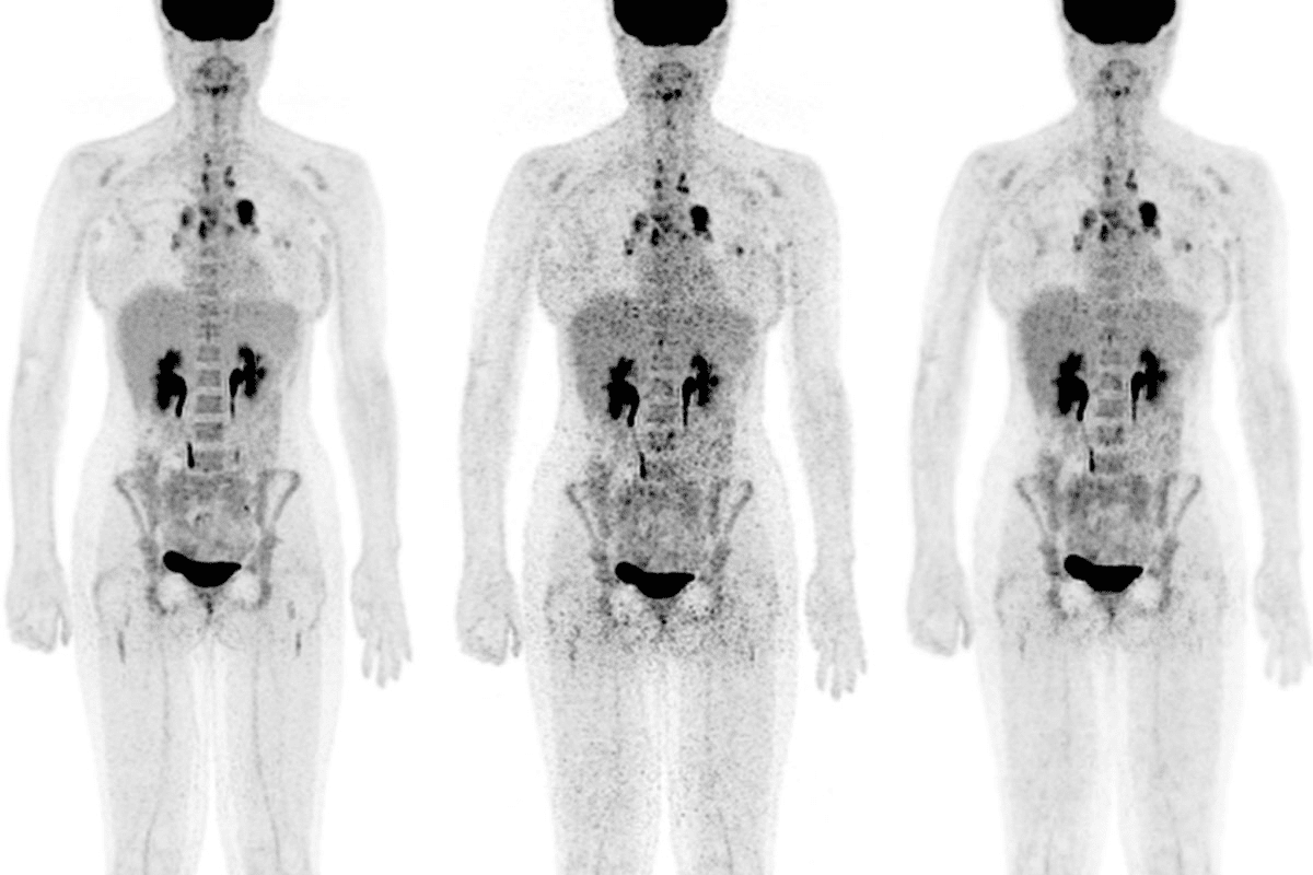Cancers Not Visible on PET Scans: Important Limitations