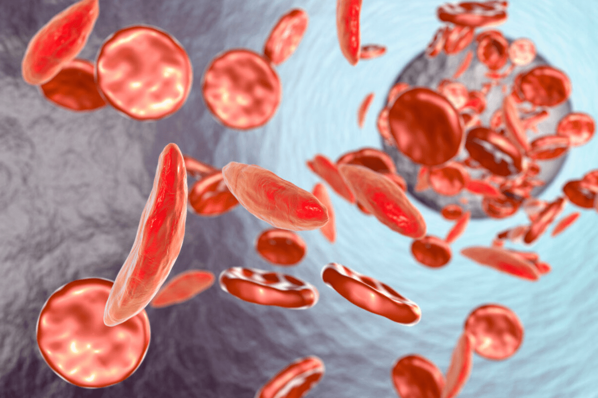 Age and Eligibility: Is There an best Age Limit for sickle cell cure Therapy? No.1