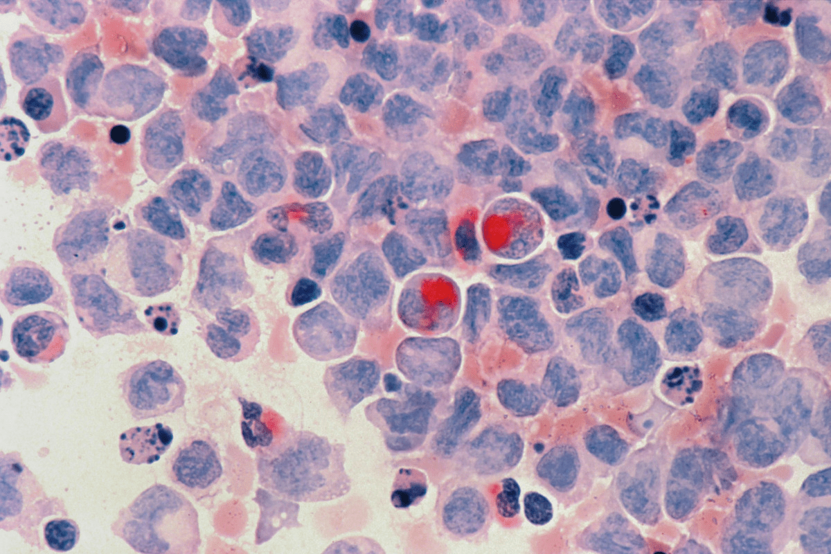 The Promise of a Cure: Can gene therapy Successfully Treat Cancer?