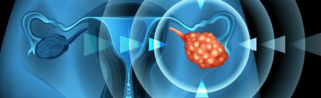 Ovarian Cancer 1 image 178 LIV Hospital