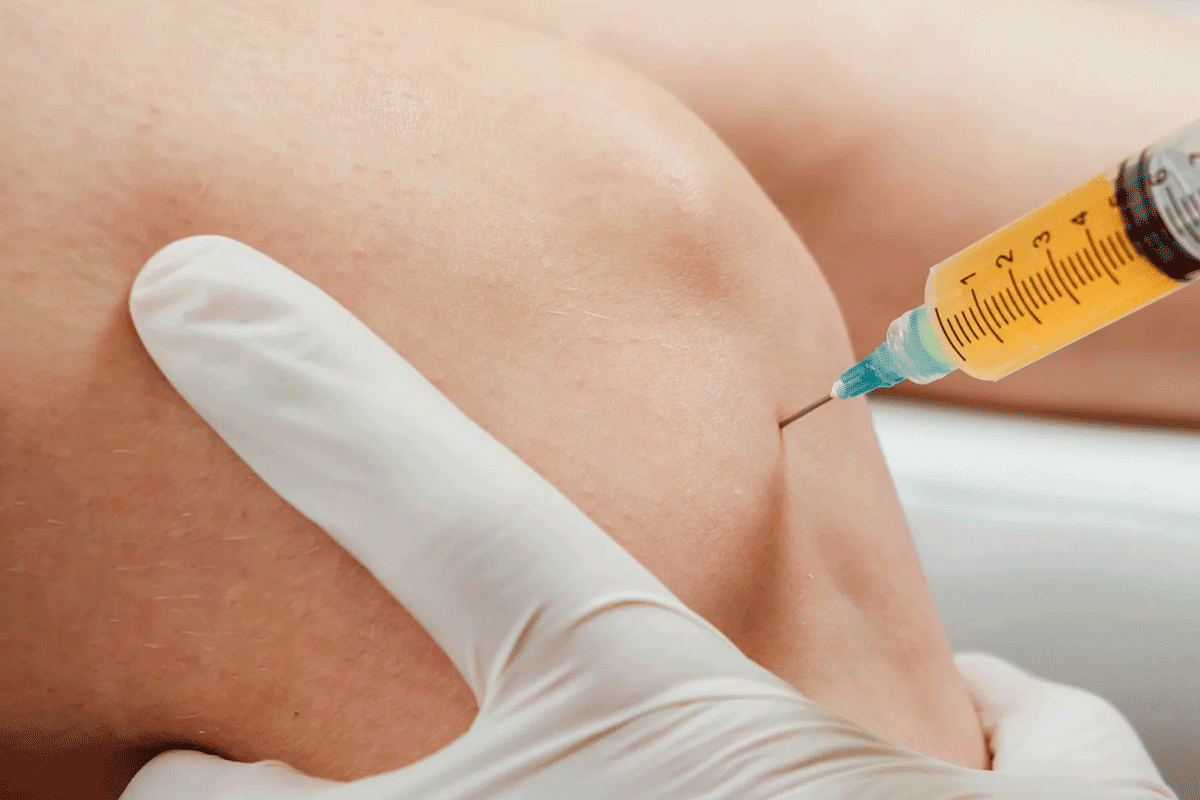 Stem Cell Therapy for Knees: What to Expect