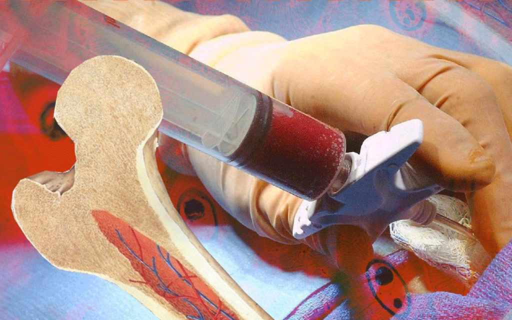 Understanding Stem Cell DNA and Bone Marrow Transplants 1 Understanding Stem Cell DNA and Bone Marrow Transplants