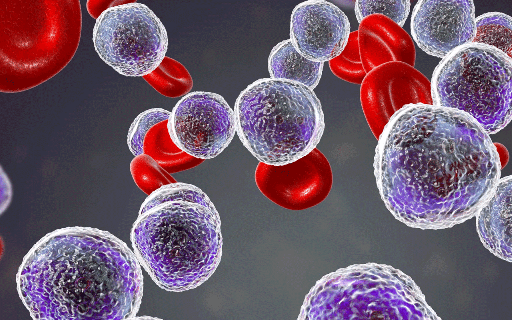 Leukemia Survival Rate: Hopeful Advances for 2025 2 Leukemia Survival Rate: Hopeful Advances for 2025