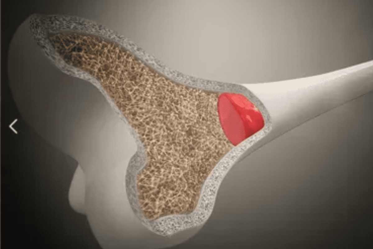 Soreness After Donation: What to Expect Following Bone Marrow Donation