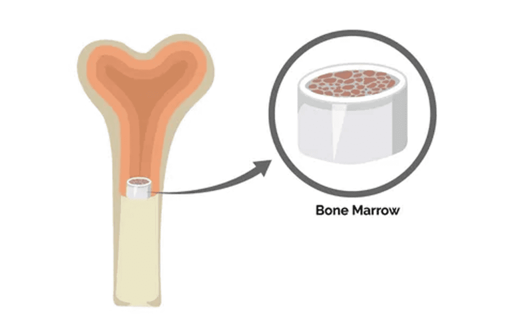 Bone Marrow Transplant Pain: Shocking Truth & Relief Guide
