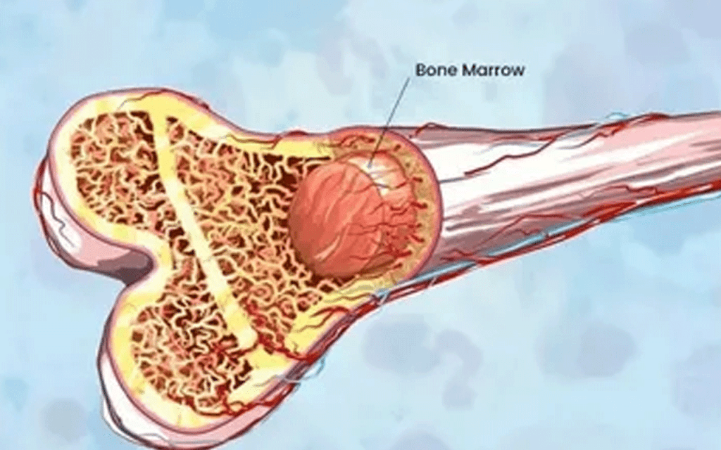 Bone Marrow Transplant Pain: Shocking Truth & Relief Guide