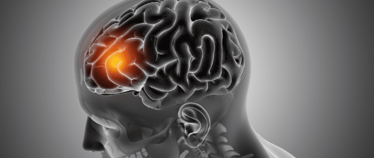 Brain Tumor Symptoms: Absolute Guide 1 Brain Tumor