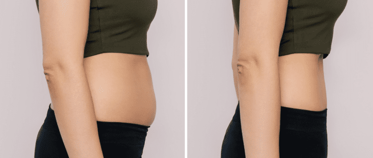 5 Effective Weight Loss Surgery Options 3 Weight Loss Surgery