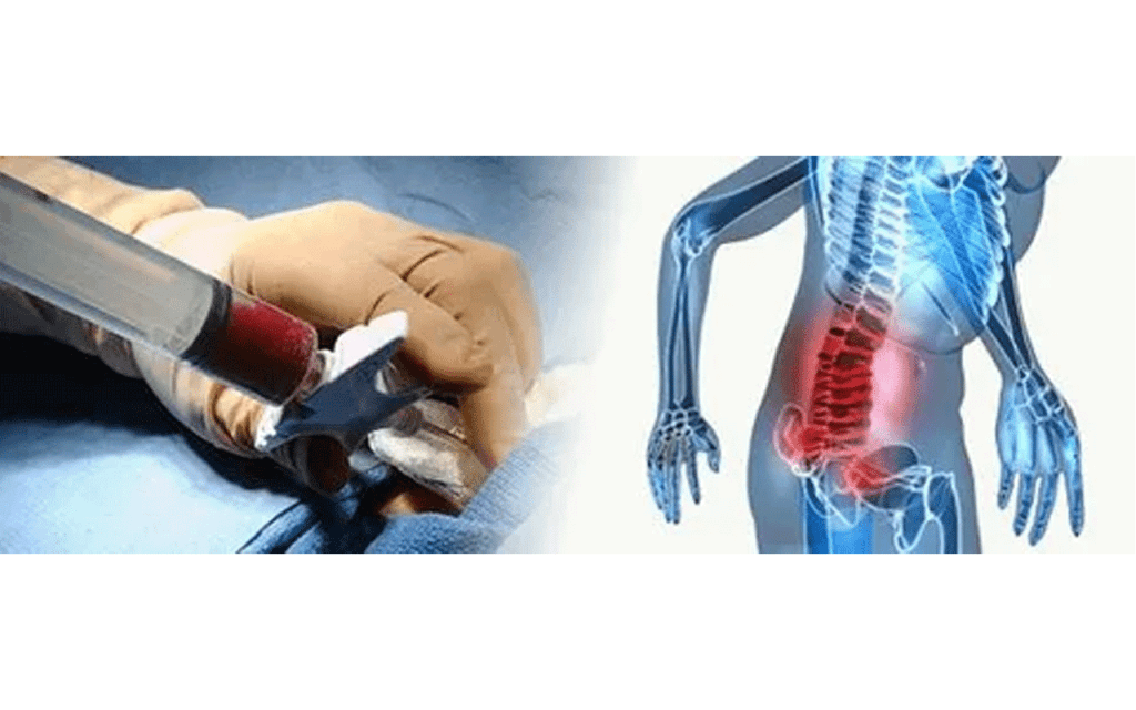 Bone Marrow Transplant Side Effects: Manage Risks & Recovery