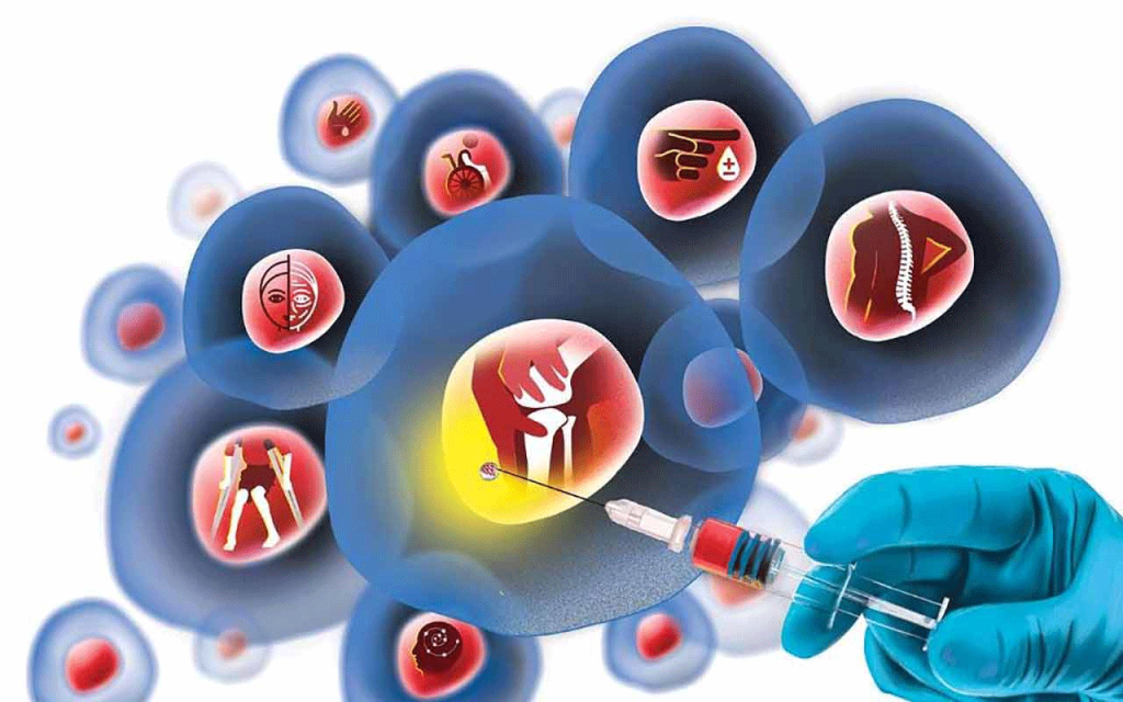 Stem Cell Therapy: An Alternative to Bone Marrow Transplant