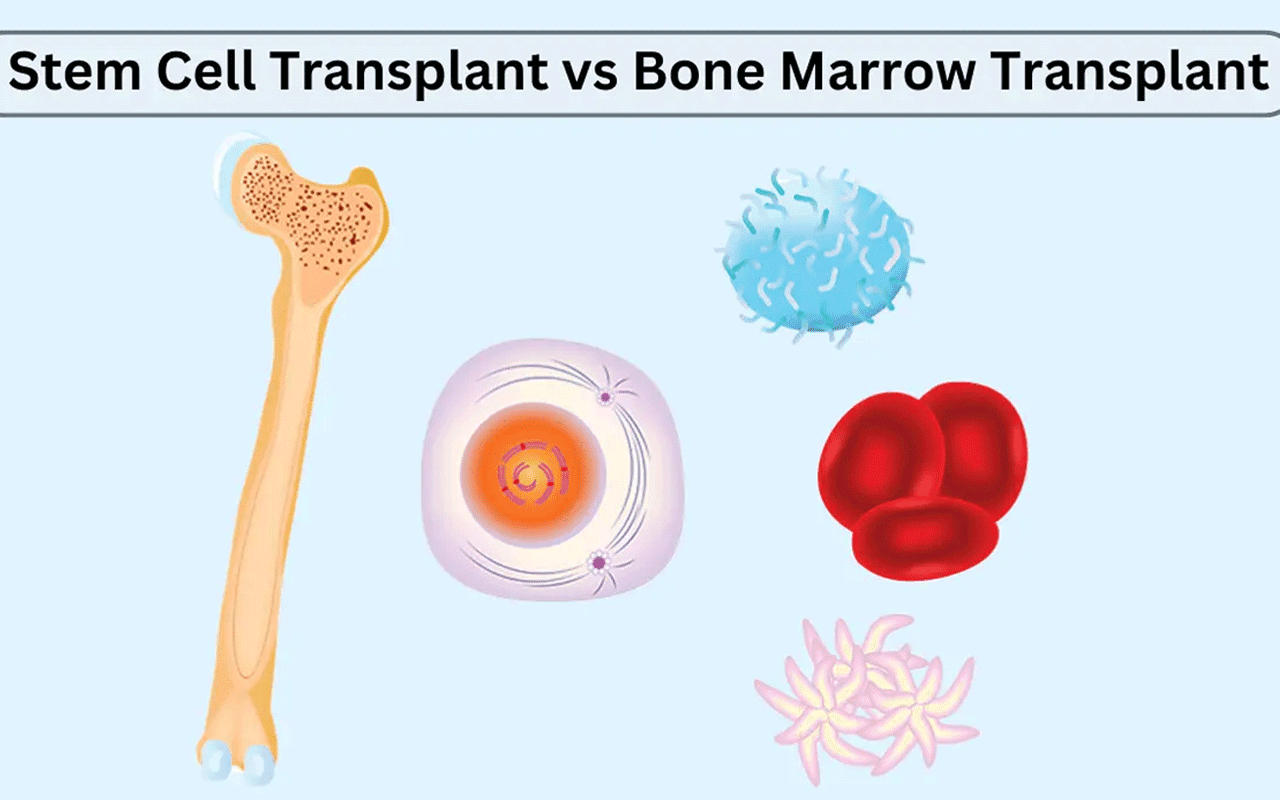 Stem Cell Therapy: An Alternative to Bone Marrow Transplant