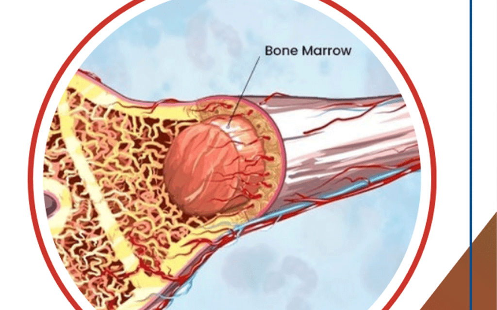 BM Transplantation: Powerful Healing with Advanced Stem Cell Therapy