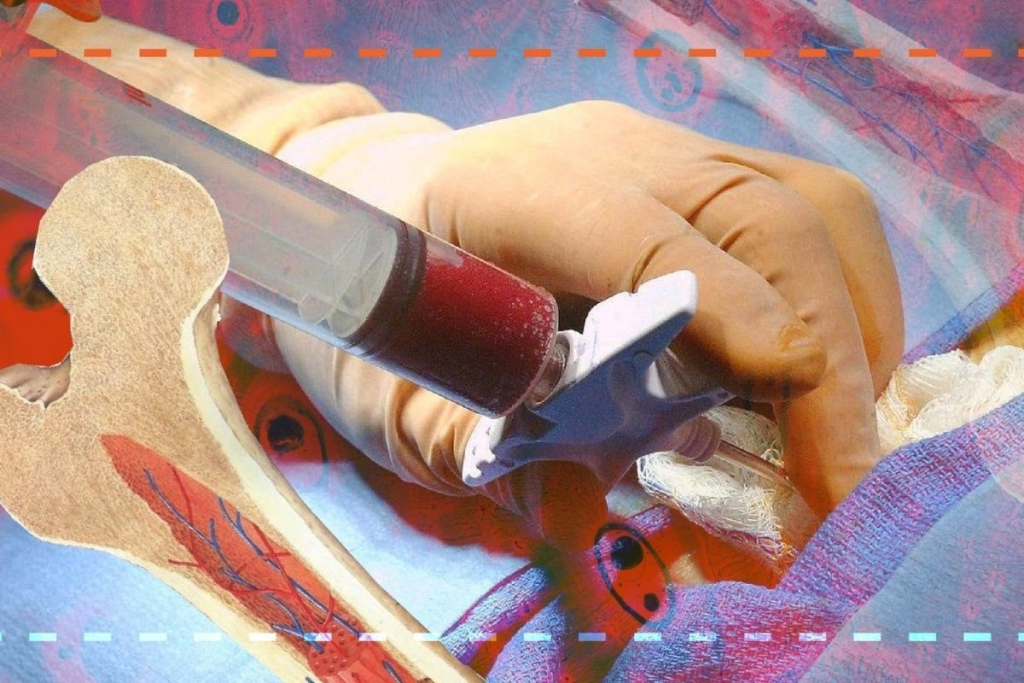 BM Transplantation: Powerful Healing with Advanced Stem Cell Therapy