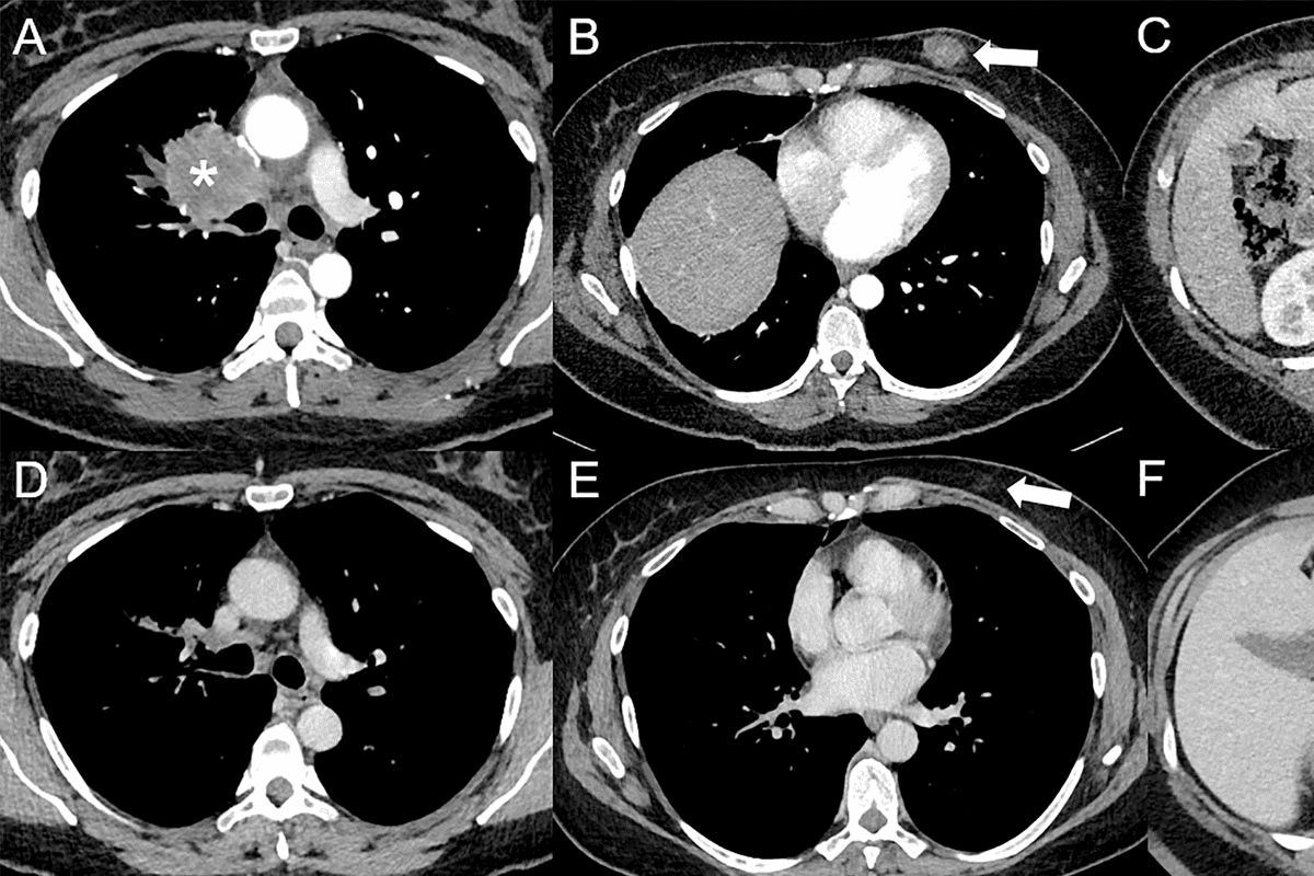 Cancers Not Visible on a PET Scan: Low-FDG Tumors and Rare Exceptions