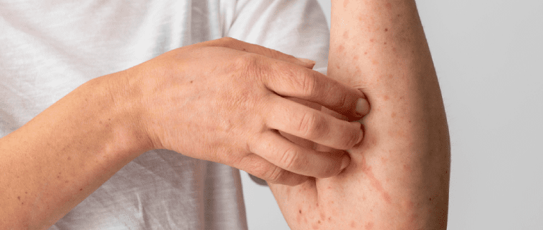 5 Effective Ways to Treat Actinic Keratosis 1 Actinic Keratosis