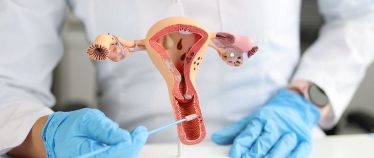 Cervical Cancer: Complete & Comfortable Guide 4 Cervical Cancer