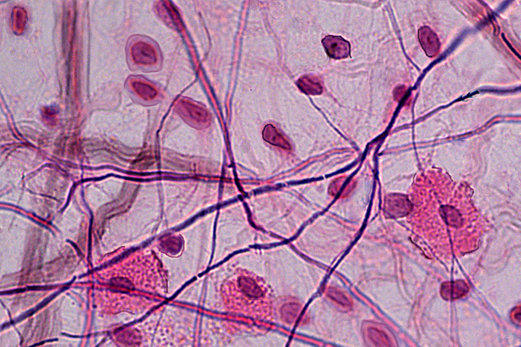 Scar Tissue PET: Powerful Imaging to Differentiate Scar and Disease 3 Scar Tissue PET: Powerful Imaging to Differentiate Scar and Disease