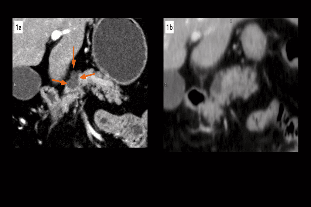 Cancerous Lung Nodule Locations: Where Malignant Nodules Often Appear 3 Cancerous Lung Nodule Locations: Where Malignant Nodules Often Appear